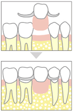 入れ歯（義歯・デンチャー）イメージ