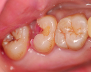 虫歯治療例２
