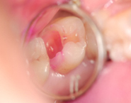 虫歯治療例３