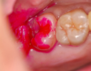虫歯治療例４
