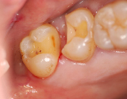 虫歯治療例５