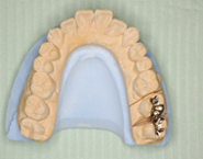 虫歯治療例７