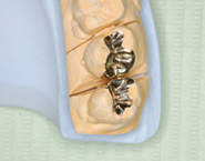 虫歯治療例８