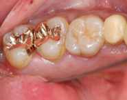 虫歯治療例９